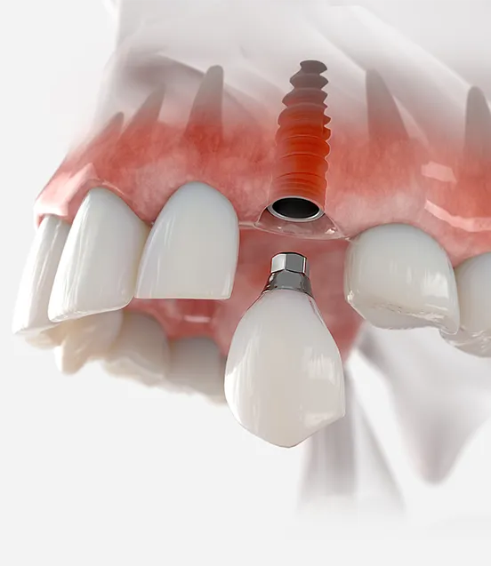 Dantų implantacija
