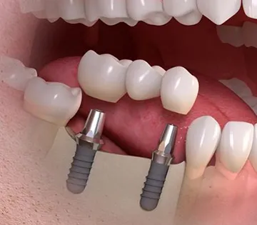 Kelių dantų implantacija
