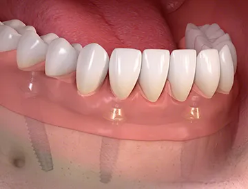 Visų dantų implantacija (All-on-4)