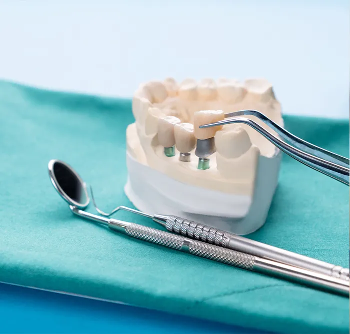 https://implantacija.lt/wp-content/uploads/2025/04/Dantu-implantacijos-etapai-4.webp
